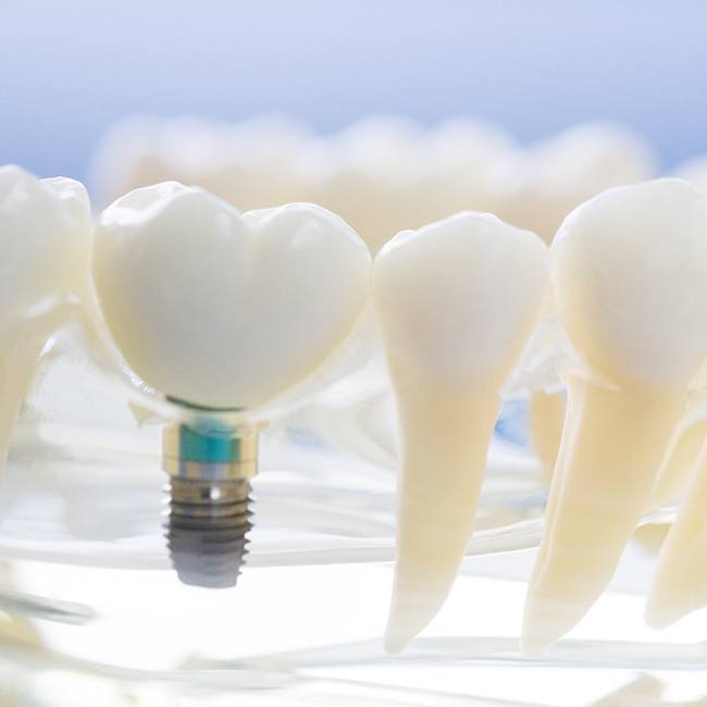 Model of dental implants in Los Angeles on model jaw