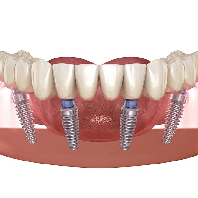 Animated all on four dental implant supported denture
