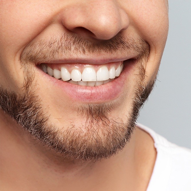 Man's smile after gum recontouring