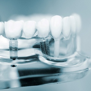 close up of dental implants in Van Nuys