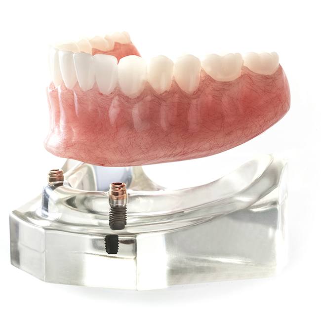 Set of dentures about to be attached to implants
