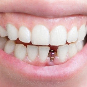 Dental implant after surgery in Los Angeles