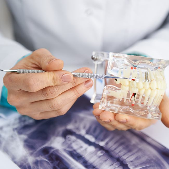 Dental implant technology in Los Angeles