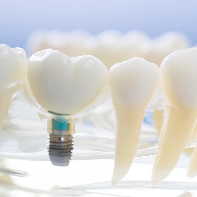 Model smile with dental implant supported dental crown