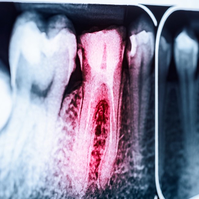 X-ray of smile with red highlighted tooth in need of root canal