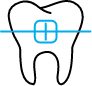 Animated tooth with traditional bracket and wire braces