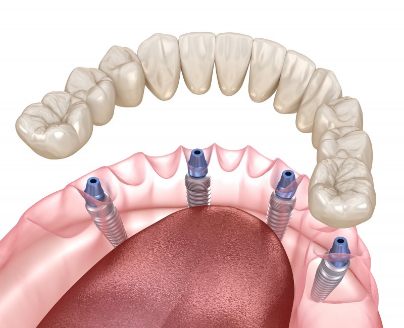 Model of dentures about to be attached to implants